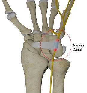 guyon's canal compression test|guyon's canal orthobullets.